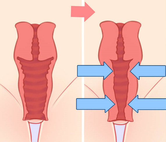 Trong phẫu thuật tạo hình âm đạo, bác sĩ làm hẹp các thành âm đạo và thậm chí còn gọi đó là trẻ hóa âm đạo. (nguồn: erufucare.com)