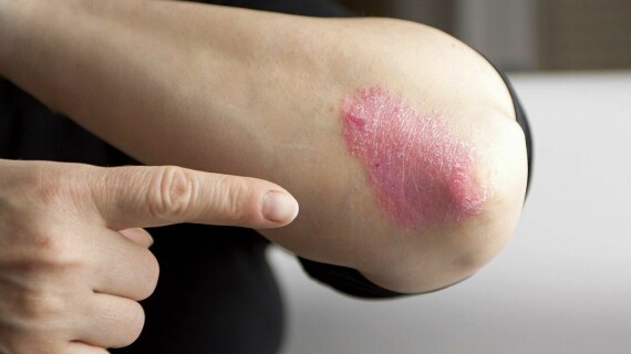 Tổn thương vảy nến thể mảng ở khuỷu tay. Theo nguồn: everydayhealth.com