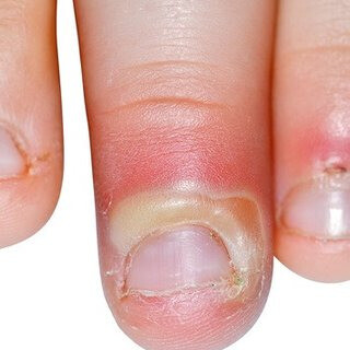 Nếu bị áp xe ở ngón tay (có mủ, gây đau nhiều) và không thể xác định nguyên nhân, hãy đi khám. (nguồn: www.researchgate.net)
