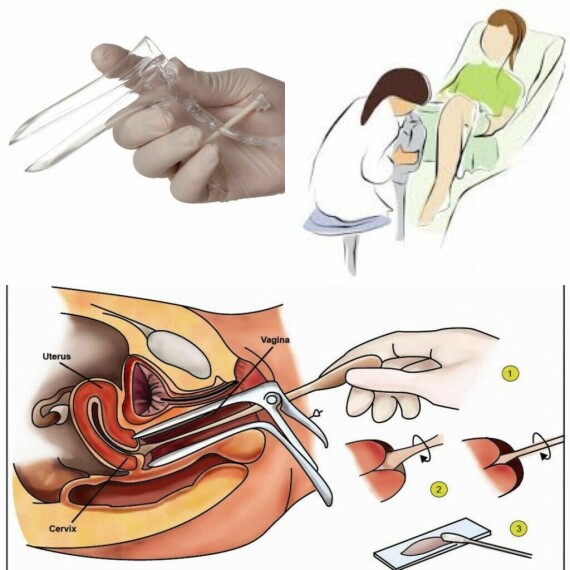 Xét nghiệm phân tích tế bào ống cổ tử cung tìm virus HPV. Nguồn ảnh: pulsinellimedicalcenter.com  