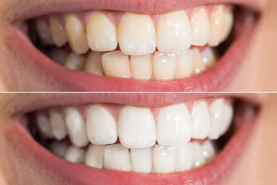 48 giờ sau tẩy trắng thì răng có nguy cơ bị nhiêm màu cao nhất. (nguồn: auroradentist.com)