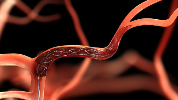 Điều trị đột quỵ bằng cách đặt một vật dụng vào mạch máu để làm tan cục máu đông, nguồn ảnh labblog.uofmhealth.org