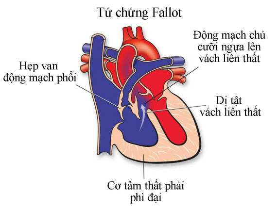 Tứ chứng Fallot. Nguồn ảnh: heart.org