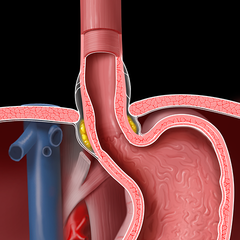 Cơ vòng thực quản dưới (Lower esophageal sphincter - LES) (Nguồn ảnh Stanford)