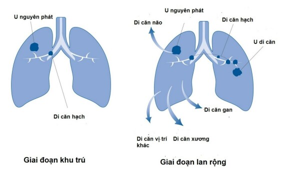 Phân chia giai đoạn ung thư tế bào nhỏ của phổi. Theo nguồn: grepmed.com.