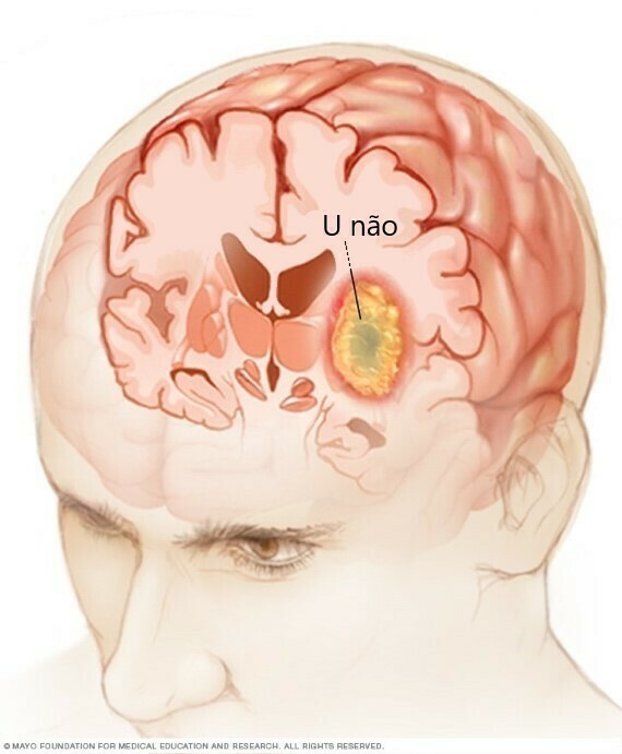 Khối u não có thể gây đau đầu, nguồn ảnh www.mayoclinic.org