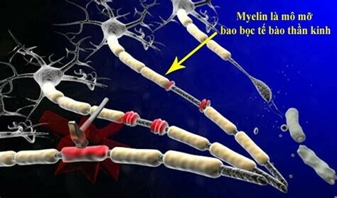 Bản chất của bệnh đa xơ cứng là do hệ thống miễn dịch phá hủy bao myelin làm tổn thương các tế bào thần kinh. Nguồn ảnh: rfa.org