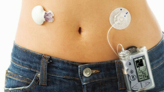 Artificial pancreas better than existing treatment for type 1 diabetes