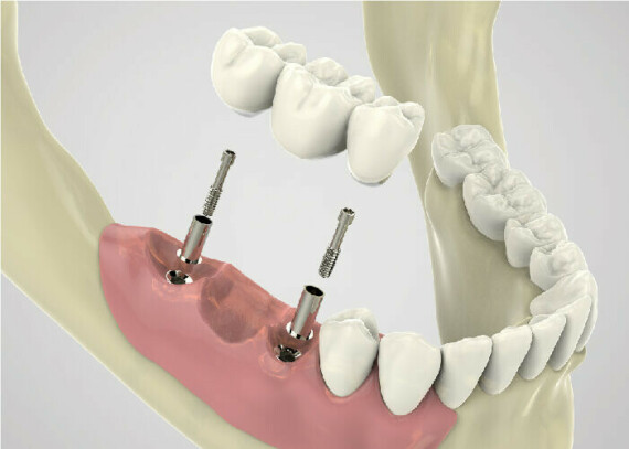 cầu răng sứ trên implant