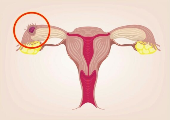 Hình ảnh miêu tả tình trạng mang thai ngoài tử cung. Ảnh: Insider.com