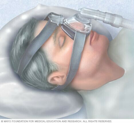 Áp lực thở dương liên tục CPAP