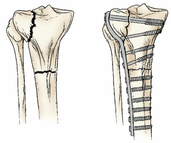 Gãy xương kéo dài vào khớp gối thường đòi hỏi phải cố định tấm.