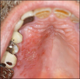 Zona thần kinh phát triển trong khoang miệng có thể gây ảnh hưởng tới vị giác. Nguồn ảnh: aafp.org