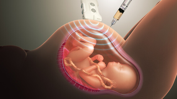 Phương pháp chọc ối cho kết quả với độ chính xác cao nhưng sản phụ có nguy cơ sảy thai và nhiễm trùng. Nguồn ảnh: www.scientificanimations.com