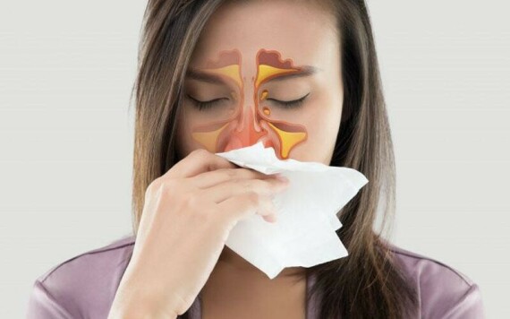 Viêm xoang có thể là nguyên nhân gây ngạt mũi và đau đầu. Nguồn ảnh: santosh.ac.in