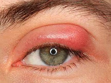 Hầu hết các nguyên nhân gây sưng mí mắt là vô hại, nhưng những vấn đề tưởng như nhỏ lại có thể khá nghiêm trọng. Vì vậy, nếu bạn bị sưng mí mắt, hãy nên tìm đến bác sĩ nhãn khoa để được thăm khám và điều trị. Nếu ai đó đã từng bị sưng mí mắt trước đây, có lẽ họ có thể tự khắc phục tình trạng này một cách an toàn tại nhà trong vài ngày. 1.	Lẹo mắt   Lẹo mắt (hordeolum) là một tình trạng nhiễm trùng tổ chức tuyến ở mí mắt. nguồn ảnh: http://neoretinaclinic.com/   Lẹo mắt (hordeolum) là một tình trạng nhiễm trùng tổ chức tuyến ở mí mắt. Loại lẹo mắt phổ biến nhất là do nhiễm trùng các tuyến nước mắt ở gốc lông mi. Lẹo mắt đôi khi cũng xảy ra bên trong mí mắt do các tuyến bã nhờn bị nhiễm trùng. Lẹo mắt thường khởi phát với các biểu hiện như xuất hiện những cục đỏ, ngứa, đau, sưng tấy. Trong vài giờ hoặc vài ngày, chúng bắt đầu giống như nhọt viêm, một số có đầu trắng. Trong hầu hết các trường hợp, nhiễm trùng chỉ ảnh hưởng đến một tuyến nước mắt hoặc tuyến bã nhờn và không cần điều trị. Chườm ấm có thể giúp giảm đau. Mọi người nên tránh dùng các sản phẩm dành cho mắt, bao gồm cả kem trang điểm và kem mắt cho đến khi lẹo biến mất. Bạn cũng đừng bao giờ cố gắng nặn lẹo mắt vì có thể làm lây lan nhiễm trùng và làm tổn thương mắt. Thuốc kháng sinh có thể được sử dụng trong những trường hợp sau: •	Một số lẹo xuất hiện cùng một lúc •	Lẹo rất đau •	Các triệu chứng xấu đi •	Sốt •	Thị lực bị suy giảm. Nếu gặp bất kỳ triệu chứng nào trong số những triệu chứng trên khi bị lẹo mắt, thì nên đi khám bác sĩ nhãn khoa.  2.	Chắp   Chắp mắt không phải là tình trạng nhiễm trùng ở mắt mà thường là hậu quả của tình trạng tắc nghẽn tuyến bã. Nguồn ảnh: https://www.laboratoires-thea.com/ Chắp (chalazion) trông giống như mụn rộp, nhưng chắp không phải là một tình trạng nhiễm trùng. Thay vào đó, chắp xuất hiện khi tuyến bã ở mí mắt bị tắc nghẽn. Những người từng bị chắp ở mắt có xu hướng bị nhiều hơn và các nốt tổn thương này có thể phát triển khá lớn. Tuy nhiên, chắp hiếm khi gây tổn thương gì cho mắt. Chúng thường tự khỏi sau vài ngày. Chườm ấm có thể giúp chắp nhanh khỏi hơn. Khi chắp phát triển với kích thước lớn, chúng có thể cản trở thị lực và gây đau đớn. Có thể khó phân biệt giữa chắp, lẹo mắt hoặc một tình trạng nhiễm trùng mắt. Nếu vết sưng không biến mất sau một vài ngày hoặc có các dấu hiệu nhiễm trùng khác như sốt thì bạn nên đi khám bác sĩ nhãn khoa.  3.	Dị ứng Nếu mí mắt bị sưng kèm theo ngứa, đỏ, chảy nước mắt thì nguyên nhân có thể là do dị ứng mắt. Bụi, phấn hoa và các chất gây dị ứng thông thường khác có thể gây kích ứng mắt, gây ra phản ứng dị ứng trên. Dị ứng ở mắt hiếm khi nguy hiểm, nhưng chúng có thể gây khó chịu. Tránh các chất gây dị ứng đã biết là biện pháp tốt nhất. Tình trạng dị ứng ở một số người sẽ thuyên giảm khi dùng thuốc kháng histamine, chẳng hạn như Benadryl. Thuốc nhỏ mắt không kê đơn cũng giúp giảm ngứa và khô mắt, nhưng nếu các triệu chứng vẫn tiếp diễn, tốt nhất nên đi khám bác sĩ nhãn khoa. Bác sĩ có thể chỉ định các xét nghiệm tìm nguyên nhân gây dị ứng và đưa ra các phương pháp điều trị thích hợp.  4.	Kiệt sức Kiệt sức hoặc mệt mỏi có thể khiến mí mắt sưng húp. Nước tích ở mô mắt qua đêm cũng khiến mắt sưng nề vào buổi sáng, đặc biệt khi trải qua một đêm không ngủ ngon. Chườm lạnh khi nằm kê cao đầu có thể hữu ích. Uống một cốc nước cũng có thể giúp giảm tích nước và sưng tấy.  5.	Khóc Khi khóc có thể làm vỡ các mạch máu nhỏ trong mắt và mí mắt, đặc biệt nếu khóc quá nhiều hoặc kéo dài. Sưng mí mắt sau khóc có thể là kết quả của việc tích nước, nguyên nhân là do sự gia tăng lưu lượng máu đến vùng xung quanh mắt. Nghỉ ngơi, chườm mát, kê cao đầu và uống nước có thể giúp cải thiện sưng nề mắt.  6.	Mỹ phẩm  Khi các sản phẩm trang điểm và chăm sóc da dính vào mắt, chúng gây kích ứng mắt và các mô xung quanh, gây sưng tấy mắt, đỏ và đau đớn. Phản ứng dị ứng với các sản phẩm mỹ phẩm cũng có thể gây sưng mí mắt. Nếu mọi người cảm thấy mắt bị nóng và sưng thì nên sử dụng nước mắt nhân tạo (thuốc nhỏ mắt) để giúp làm dịu cảm giác khó chịu. Nếu tình trạng bỏng rát vẫn kéo dài hoặc trở nên tồi tệ hơn, nên đi khám bác sĩ nhãn khoa. Tránh sử dụng thuốc nhỏ làm trắng mắt hoặc bất kỳ sản phẩm nào khác để giảm đau. Những sản phẩm này có thể gây ra các phản ứng không mong muốn cùng với các sản phẩm trang điểm và chăm sóc da khác.  7.	Viêm tổ chức hốc mắt  Viêm tổ chức hốc mắt là tình trạng nhiễm trùng sâu trong mô của mắt. Tình trạng này có thể lan ra nhanh chóng và thường gây cảm giác cực kỳ đau đớn. Ngay cả một vết xước nhỏ cũng là cơ hội cho vi khuẩn gây viêm tổ chức hốc mắt. Nếu mí mắt rất đau, đỏ, có vệt hoặc sưng thì nên khẩn trương tới cơ sở y tế để được thăm khám. Viêm tổ chức hốc mắt là một bệnh nhiễm trùng nghiêm trọng cần điều trị bằng kháng sinh. Tùy thuộc vào mức độ nghiêm trọng của nhiễm trùng, có thể cần phải tiêm thuốc kháng sinh tiêm tĩnh mạch. 8.	Bệnh Basedow  Bệnh Basedow là một rối loạn nội tiết gây ra tình trạng tuyến giáp hoạt động một cách quá mức. Tình trạng này có thể khiến tuyến giáp giải phóng nhầm các tế bào để chống lại tổ chức bình thường trong mắt, gây sưng và viêm mắt. Một loạt các phương pháp điều trị cho bệnh Basedow như phẫu thuật tuyến giáp hay điều trị thuốc theo đơn.  9.	Mụn rộp ở mắt  Mụn rộp hay herpes ở mắt là một bệnh nhiễm trùng herpes trong và xung quanh mắt. Mặc dù bất kỳ ai cũng có thể bị mụn rộp ở mắt, nhưng tình trạng này phổ biến nhất ở trẻ em. Mụn rộp ở mắt có thể trông giống như đau mắt đỏ nhưng không phải lúc nào các tổn thương cũng biểu hiện một cách rõ ràng. Để chẩn đoán tình trạng mụn rộp, bác sĩ sẽ cần phải cấy tổ chức tổn thương để kiểm tra sự hiện diện của vi rút. Mặc dù vi rút vẫn còn trong cơ thể và không có cách chữa trị, nhưng thuốc kháng vi rút có thể kiểm soát các triệu chứng này.  10.	Viêm bờ mi  Một số người có nhiều vi khuẩn trong và xung quanh mí mắt hơn những người khác, có thể gây ra một tình trạng gọi là viêm bờ mi. Những người bị viêm bờ mi gây ra tình trạng mí mắt nhờn và vảy giống như gàu xung quanh lông mi. Một số người bị viêm bờ mi nặng, mí mắt sẽ bị viêm và gây đau. Viêm bờ mi là một tình trạng mạn tính không có thuốc điều trị đặc hiệu. Thay vào đó, nó có xu hướng bùng phát các triệu chứng nhanh hơn và sau đó tồi tệ hơn. Chườm ấm, tẩy trang cẩn thận cho mắt và tẩy tế bào chết mí mắt có thể giúp cải thiện bệnh. Bác sĩ nhãn khoa có thể kê đơn thuốc mỡ kháng sinh điều trị tình trạng viêm bờ mi này. Đôi khi, viêm bờ mi dẫn đến nhiễm trùng nặng hơn. Nếu đợt bùng phát viêm bờ mi nặng hơn những đợt trước, hoặc bị đau dữ dội, hãy đi khám bác sĩ nhãn khoa.  11.	Tắc ống lệ   Khi ống lệ - ống dẫn nước mắt - bị tắc, mắt không thể dẫn lưu nước mắt dẫn đến đau và đỏ mí mắt. Những người bị tắc ống lệ cũng có thể xuất hiện dịch tiết kèm vảy khiến đôi mắt bị bịt kín khi thức dậy. Trẻ sơ sinh và trẻ nhỏ đặc biệt rất dễ bị tắc nghẽn ống lệ. Các triệu chứng thường cải thiện khi trẻ được 1 tuổi. Trong hầu hết các trường hợp, ống lệ bị tắc gây khó chịu nhưng không có hại. Chườm ấm để làm dịu vết sưng tấy và giúp ống lệ tiết dịch. Thử xoa bóp nhẹ nhàng khu vực này để giảm áp lực và thông ống lệ. Ống lệ bị tắc đôi khi có thể do nguyên nhân nhiễm trùng. Nếu mí mắt rất đau hoặc người bệnh bị sốt kèm theo thì nên đi khám ngay. Tình trạng nhiễm trùng này có thể cần điều trị bằng kháng sinh. Nếu các ống lệ bị tắc không thông thoáng, bác sĩ có thể cần phải thực hiện một thủ thuật y tế để dẫn lưu chúng.  12.	 Viêm kết mạc    Viêm kết mạc còn được hay gọi là đau mắt đỏ, do vi rút gây ra và thường tự khỏi. Nguồn ảnh: https://www.medicalnewstoday.com/ Viêm kết mạc, còn được gọi là đau mắt đỏ, là tình trạng viêm kết mạc mắt - là mô mỏng, giữa mí mắt và nhãn cầu. Những người bị đau mắt đỏ thường có nhãn cầu màu hồng hoặc đỏ và có thể bị đau, ngứa và sưng mí mắt. Dạng viêm kết mạc phổ biến nhất là tình trạng nhiễm trùng do vi rút và sẽ tự khỏi sau 7-10 ngày. Tuy nhiên, nhiễm trùng do vi khuẩn cũng có thể gây ra viêm kết mạc. Đôi khi, dị ứng hoặc chất kích thích như nước hoa cũng làm kích ứng mắt, gây viêm kết mạc. Chườm ấm có thể giúp giảm đau. Để phòng viêm kết mạc, nên: •	Giữ cho mắt sạch và trang điểm vào mắt •	Tránh dụi hoặc chạm vào mắt •	Rửa tay thường xuyên để ngăn ngừa sự lây lan của nhiễm trùng. Nếu các triệu chứng trở nên trầm trọng hơn, cơn đau trở nên nghiêm trọng, hoặc mắt đỏ không thuyên giảm sau một vài ngày, bạn cần đi khám bác sĩ để được chẩn đoán và điều trị đúng, thậm chí cần điều trị thuốc kháng sinh.   Theo nguồn: https://www.medicalnewstoday.com/articles/318219