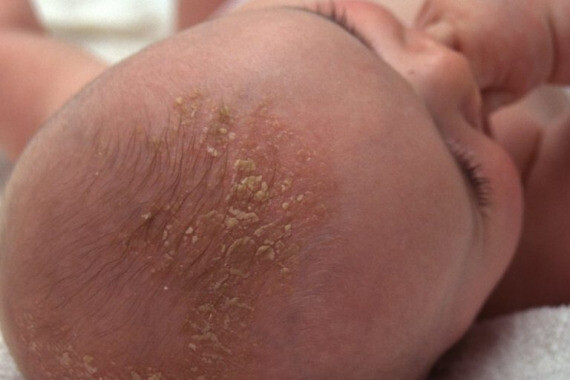 Trẻ sơ sinh hay gặp tình trạng viêm da tiết bã, hay tên thường gọi là cứt trâu, ở đầu và lông mày.(nguồn: tutburypractice.co.uk)