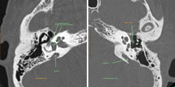 Hình ảnh cắt lớp vi tính cho thấy cống tiền đình giãn rộng cả hai bên trên bệnh nhân này. Nguồn ảnh: researchgate.net