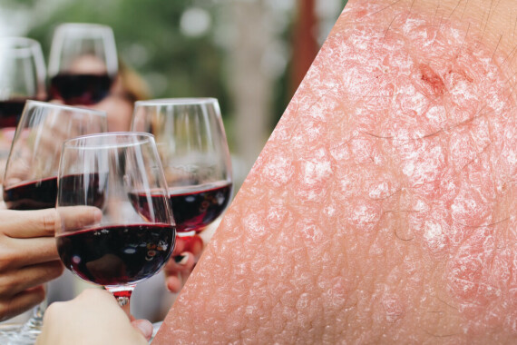 Rượu có nguy cơ làm nặng triệu chứng bệnh vảy nến. Theo nguồn: skintherapyletter.com