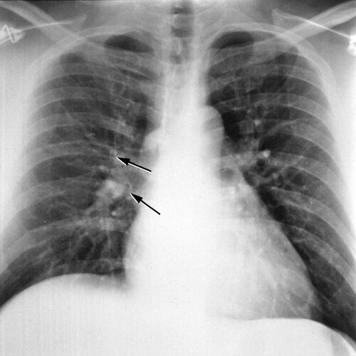 Chụp x-quang có thể phát hiện ra phù phổi cấp, nguồn ảnh pubs.rsna.org