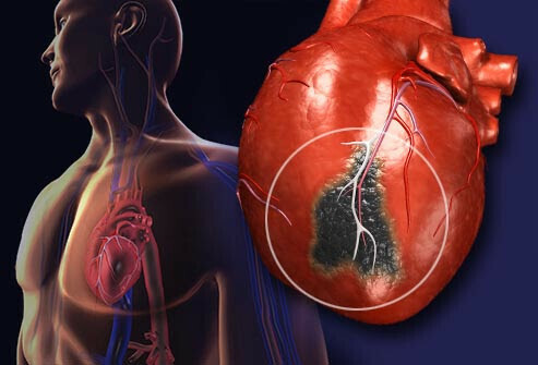 Nhồi máu cơ tim là một biến chứng vô cùng nguy hiểm. Nguồn ảnh: http://m.yersinclinic.com