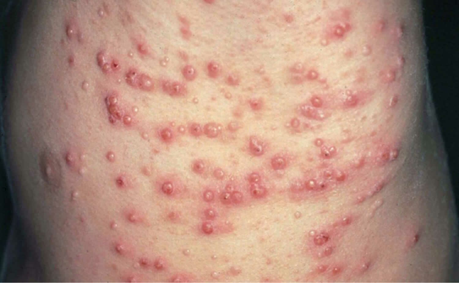 U vàng phát ban (eruptive xanthomatosis) gặp ở bệnh nhân tiểu đường (Nguồn healthjade.net)