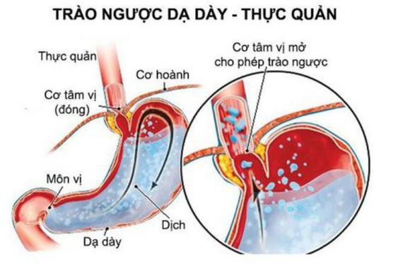 Sự bất thường trong chức năng của cơ thắt dưới thực quản là nguyên nhân chính dẫn tới chứng trào ngược. Nguồn: emedicinehealth.com