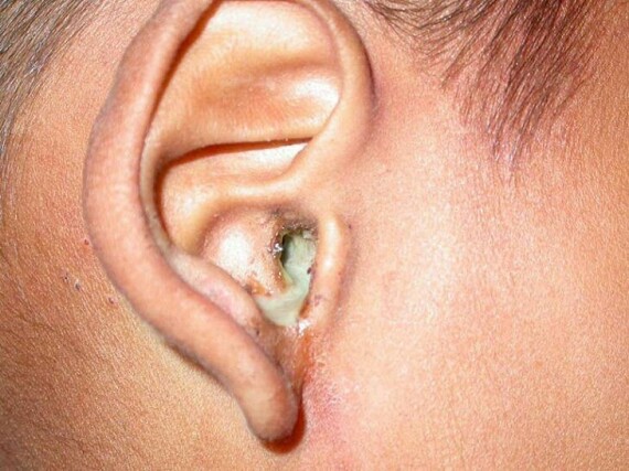 Viêm tai giữa không được điều trị có thể gây ra ù tai