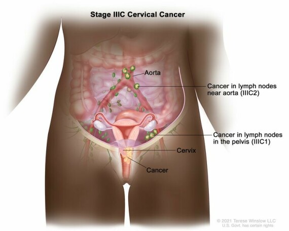 Giai đoạn IIIC ung thư cổ tử cung. Trong giai đoạn IIIC1, ung thư đã lan đến các hạch bạch huyết trong xương chậu. Trong giai đoạn IIIC2, ung thư đã lan đến các hạch bạch huyết ở bụng gần động mạch chủ.