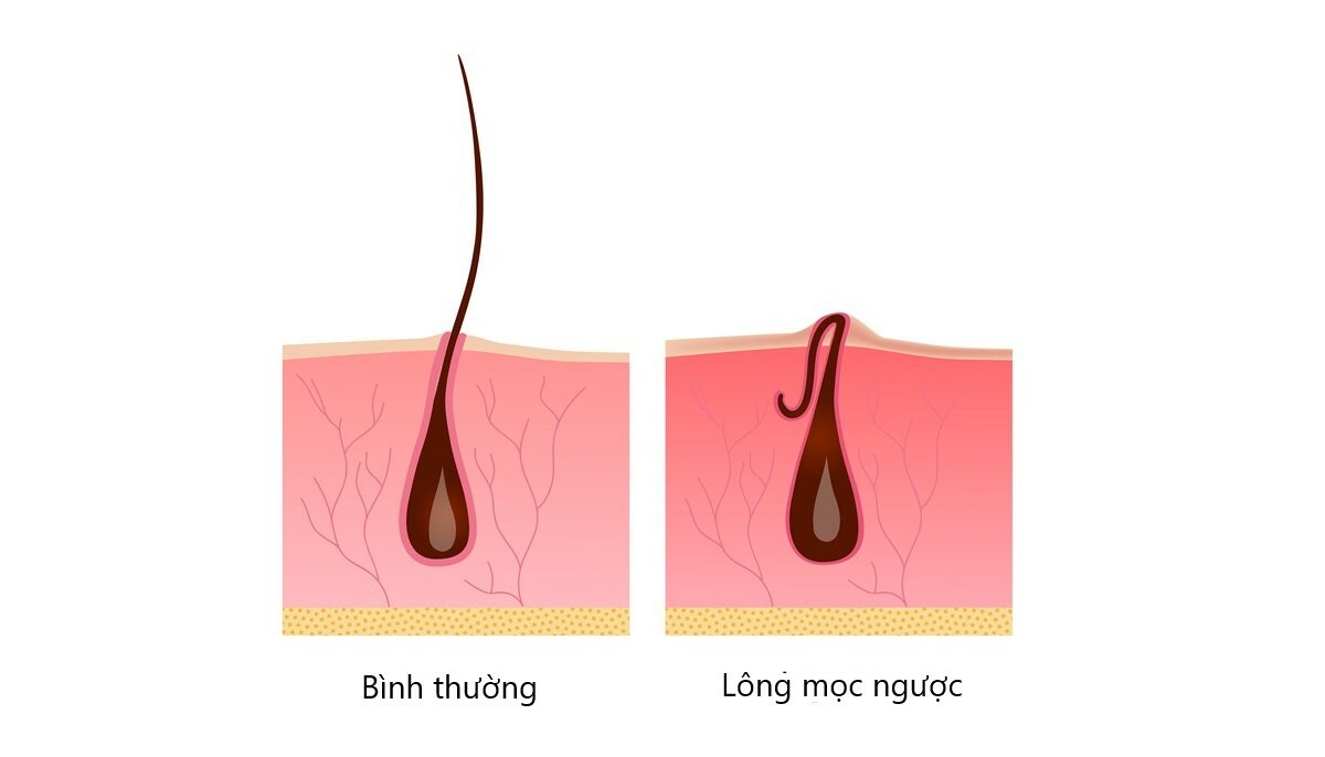 Những điều cần biết về lông mu mọc ngược: Nguyên nhân, điều trị và phòng ngừa - Ảnh 1