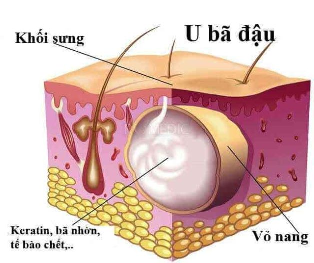 U bã đậu ở bộ phận sinh dục trẻ nhỏ có liên quan đến môi trường sống hay thói quen sinh hoạt của trẻ không?
