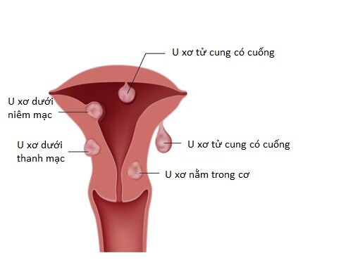 Phân loại u xơ tử cung theo vị trí. Nguồn ảnh: denverfibroids.com