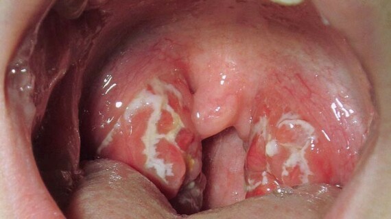 Viêm họng do liên cầu khuẩn có các mảng trắng phủ amidan và họng (Nguồn ảnh Healthine)