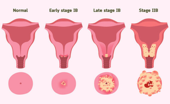 Tử cung bình thường và tử cung bị ung thư. Nguồn ảnh: www.parkwayeast.com.sg