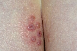 Ảnh: Herpes sinh dục. Nguồn: https://www.nhs.uk/