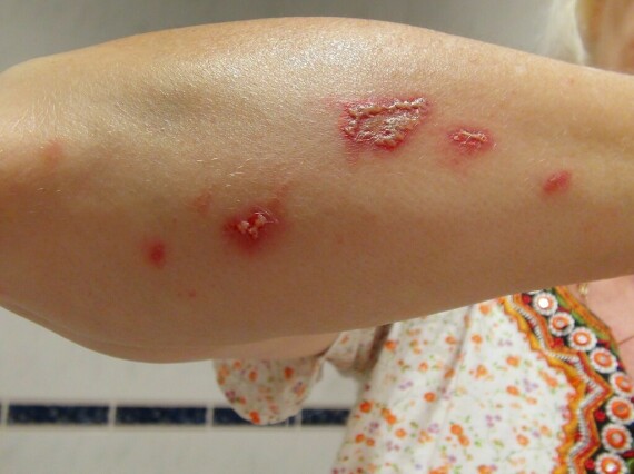 Trong viêm da do kiến ba khoang, tổn thương là những dát đỏ, mụn nước. Nguồn:   flickr.com.