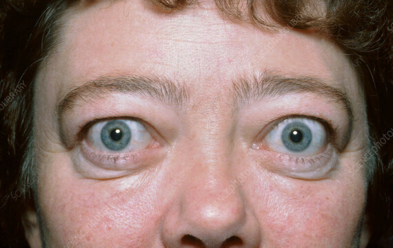 Triệu chứng mắt lồi trong bệnh Basedow, nguồn: https://www.sciencephoto.com .Chẩn đoán và điều trị bệnh Basedow