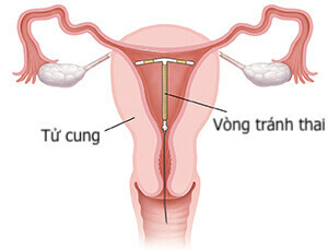 (Vòng tránh thai ảnh hưởng tới chu kỳ kinh nguyệt - nguồn ảnh: Women's vita medical clinic)
