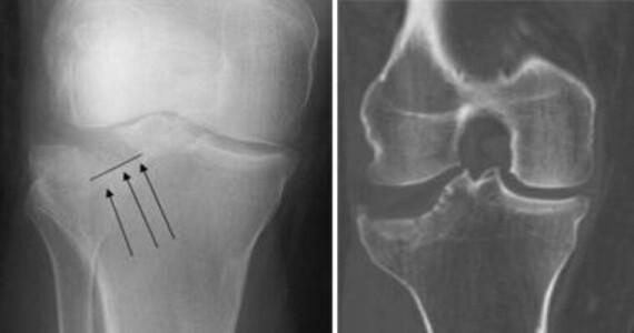 Các bác sĩ thường sử dụng cả chụp X-quang (trái) và chụp CT (phải) để xác định vị trí và sự dịch chuyển của các mảnh xương gãy.