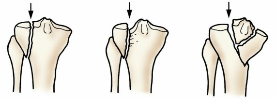 Các loại gãy xương chày xâm nhập vào khớp và ảnh hưởng đến mâm chày.