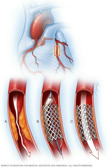 Stent động mạch vành (Nguồn ảnh mayoclinic.org)