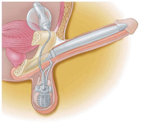 Thiết bị cấy ghép dương vật là một phương pháp hiệu quả giúp cải thiện chứng rối loạn cương dương, nguồn ảnh advancedurologyinstitute.com
