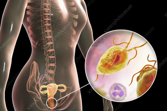 Trichomonas lây truyền qua đường tình dục gây viêm âm đạo (nguồn ảnh: https://www.sciencephoto.com/)