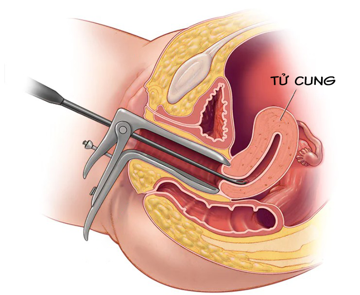 Thủ thuật nong và nạo tử cung. Nguồn ảnh: mayoclinic.org