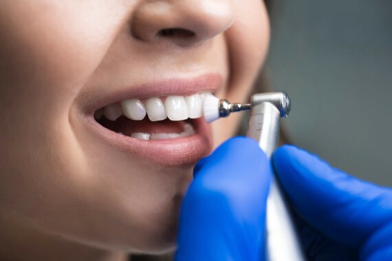 Sau khi lấy sạch cao răng bằng đầu lấy cao siêu âm, điều dưỡng nha khoa hay nha sĩ sẽ chải toàn bộ răng bạn bằng bàn chải điện công suất lớn có sử dụng bột đánh bóng. (nguồn: cmrdentalcare.com)