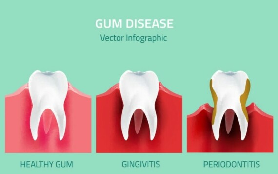 Căng thẳng có thể gây bệnh về răng miệng, trong đó có bệnh nha chu (nguồn: www.artofsmilespasadena.com/)