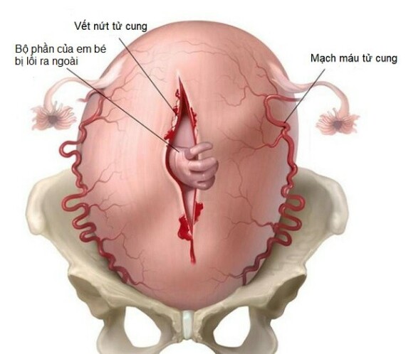 Vỡ tử cung là biến chứng rất nguy hiểm, cần chỉ định mổ lấy thai ngay lập tức. Nguồn: youmed.vn