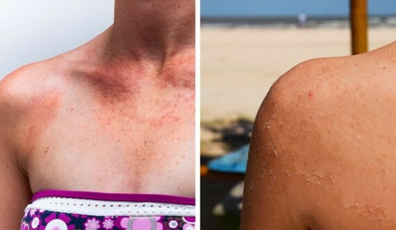 Sử dụng thuốc kháng sinh làm cho da trở nên nhạy cảm hơn với ánh nắng mặt trời. Nguồn ảnh: brightside.me