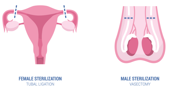 Thắt vòi tử cung ở nữ và thắt ống dẫn tinh ở nam giới. Nguồn ảnh: menmd.com