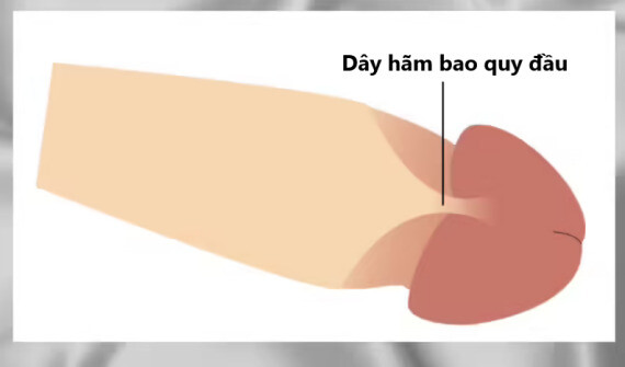 Dây hãm bao quy đầu là dải mô ngắn nối bao quy đầu với đầu dương vật khi chưa cắt bao quy đầu. (nguồn: etsy.com)